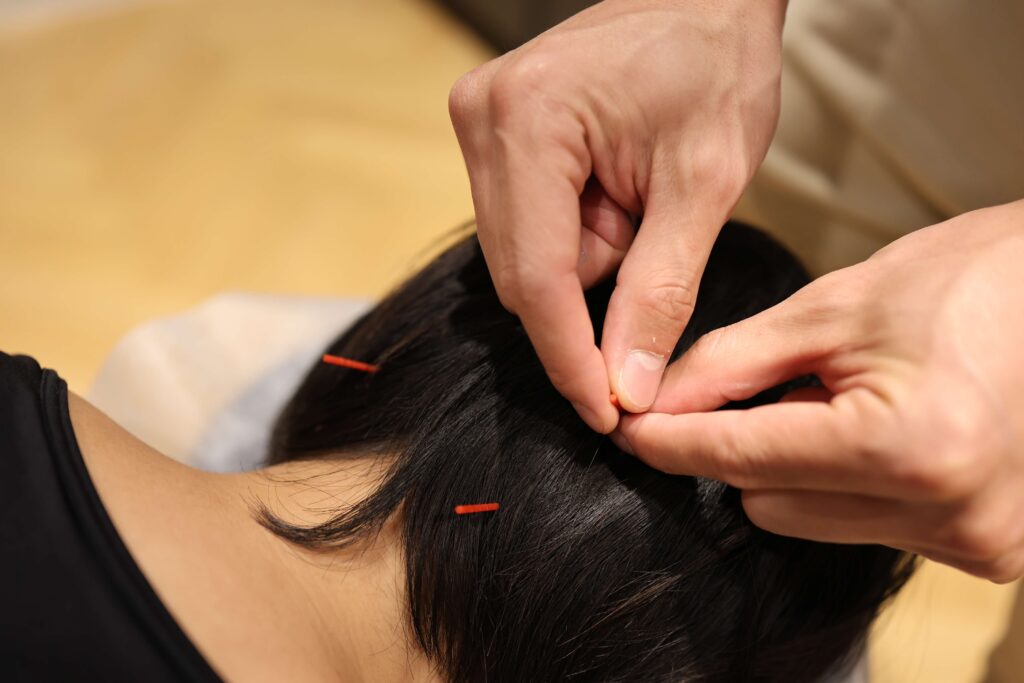 Begrijpen van Stress en Hoe Acupunctuur Helpt