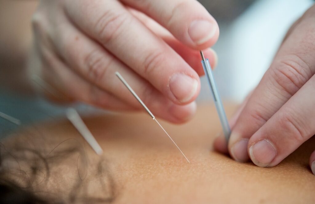 Acupunctuur bij slaapproblemen: een natuurlijke oplossing in Amsterdam | Alter Physio Amsterdam