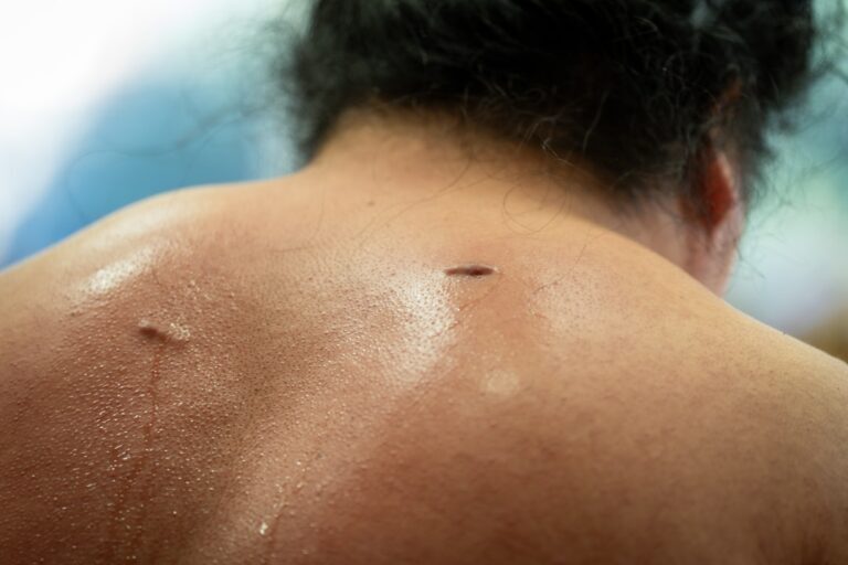 Hoe acupunctuur kan helpen bij chronische pijn in Amsterdam | Alter Physio Amsterdam